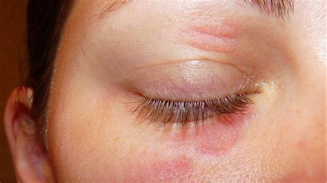 Eczema On Eyelid Pictures Photos