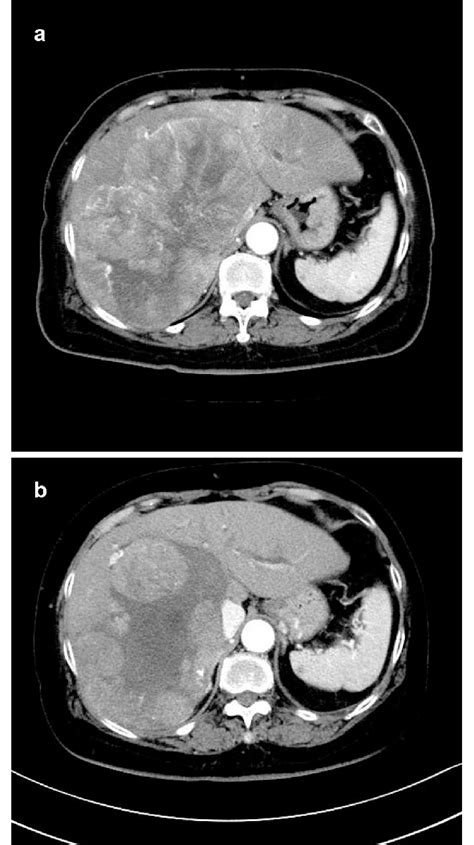 Case 3 A Contrast Enhanced Ct Before Commencement Of Lenvatinib