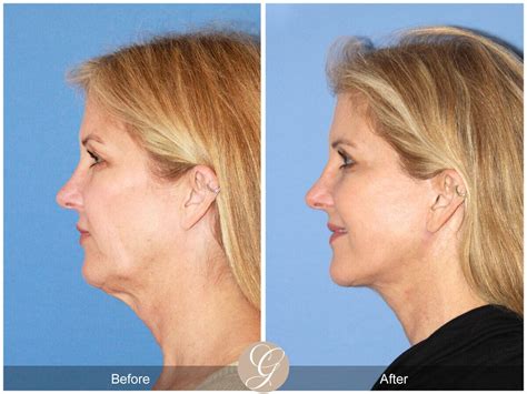 Neck Lift Before And After Photos Patient 103 Dr Kevin Sadati