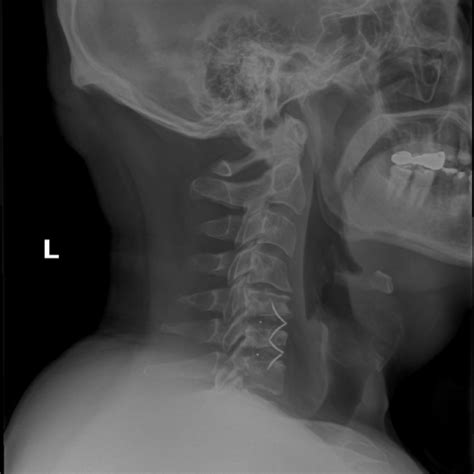 Case Study Mri Cervical Spine Without Contrast Cervical Center