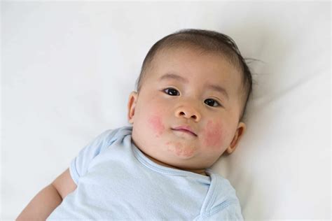 Baby Acne What Causes Them And How You Can Prevent Being The Parent