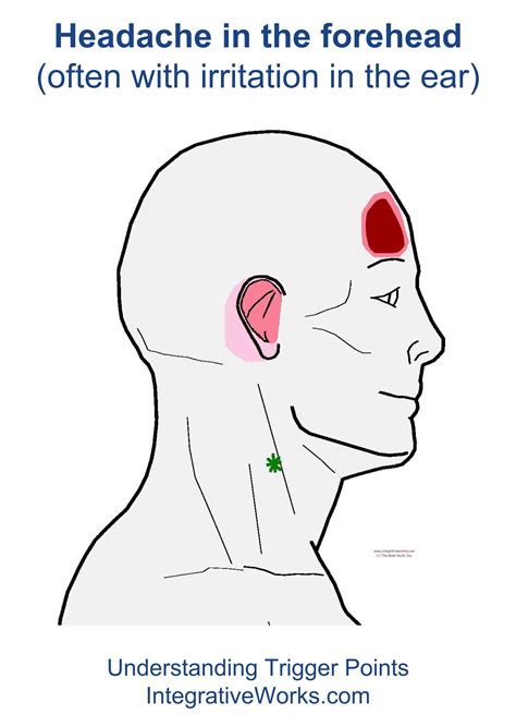 Trigger Points Headache In The Forehead Integrative Works