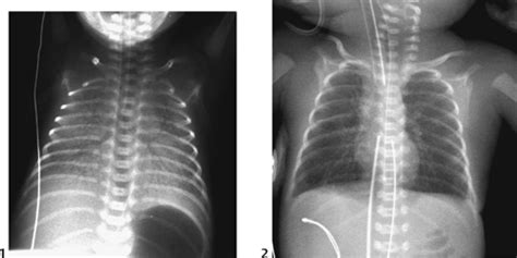 Hyaline Membrane Disease Radiology Key