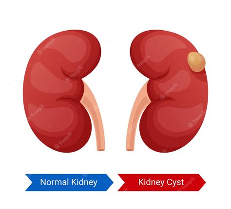 Premium Vector Illustration Of Normal Kidney And Kidney Cyst Design