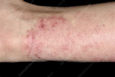 Eczema Stock Image C0294900 Science Photo Library