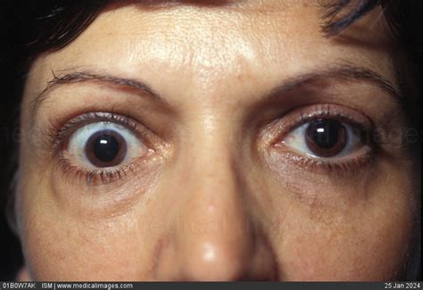Stock Image Exophthalmic Of The Right Eye Caused By Graves Disease