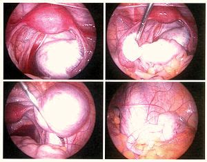 Endometriosis can affect women of any age. Category:Endometriosis - Wikimedia Commons