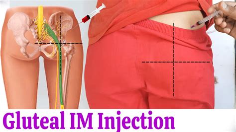 How To Give Im Intramuscular Injection In Buttock Or Hip Easily At