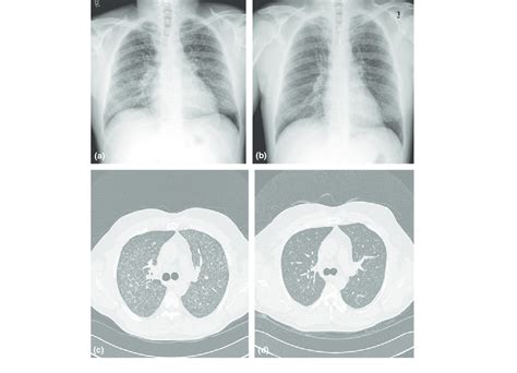 A The Initial Posterioranterior Pa Chest Radiograph Shows Diffuse