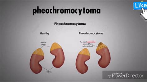 Pheochromocytoma Youtube