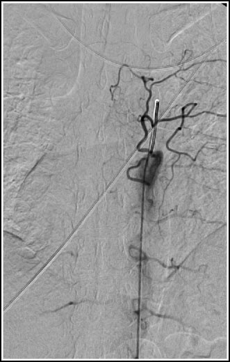 Spinal Angiography Radiology Key