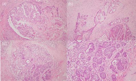 Histologic Features Of A Case Of Mucoepidermoid Carcinoma Mec Mixed