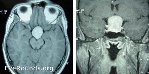 Pituitary Tumor Pituitary Tumor Ophthalmology