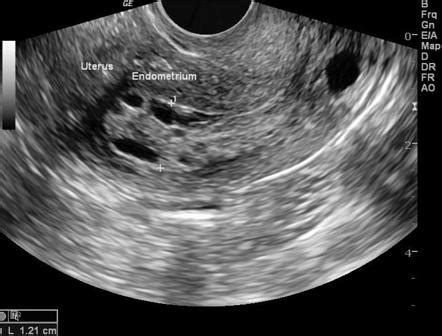 Endometrial hyperplasia | Radiology Reference Article | Radiopaedia.org