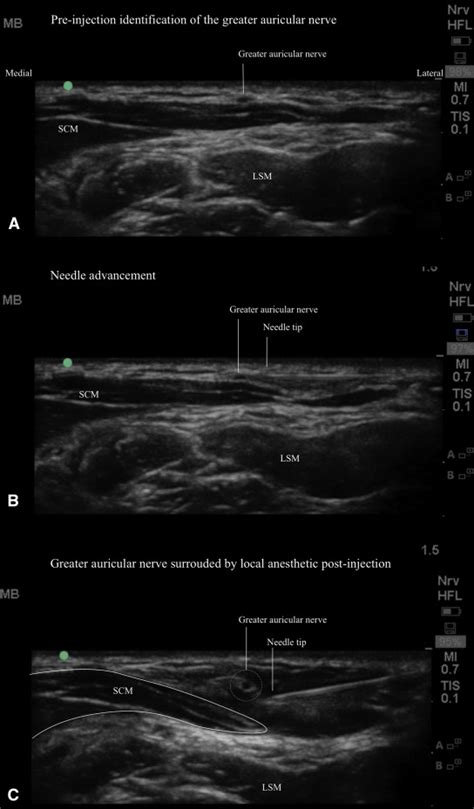 Ultrasound Guided Greater Auricular Nerve Block For Emergency