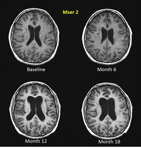 Multiple Sclerosis Research Brain Shrinking Occurs Early In Ms