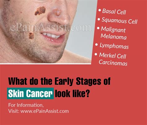 What Do Early Stages Of Skin Cancer Look Like Valley