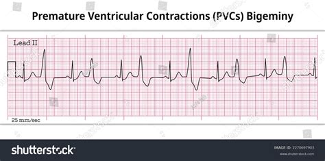 Bigeminy Premature Ventricular Contractions Pvcs Ventricular Stock