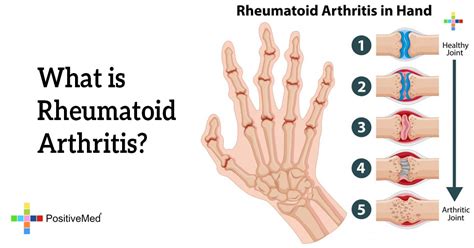 What Is Rheumatoid Arthritis Positivemed