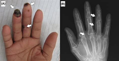 Calciphylaxis Of The Fingers Harada 2020 Journal Of General And