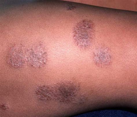 Eczema Skin Rashes That Look Like