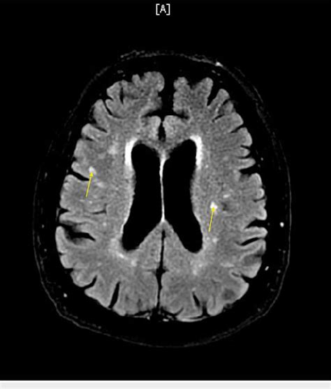 Mri Brain Without Contrast Showing White Matter Hyperintensities