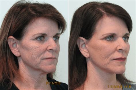 Fraxel Laser Before And After Pores Change Comin
