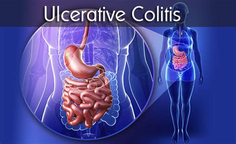 What Is Ulcerative Colitis Symptoms Causes Diagnosis Treatment