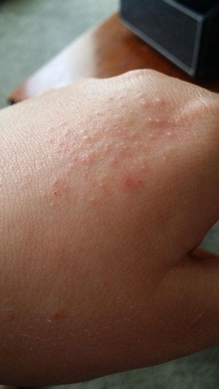 So Many Bumps But So Itchy Popping