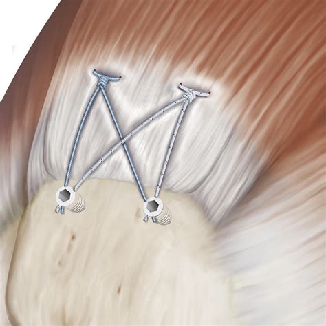 The Evolution Of Suture Anchors In Arthroscopic Rotator Cuff Repair