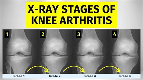 X Ray Stages Of Knee Arthritis Youtube
