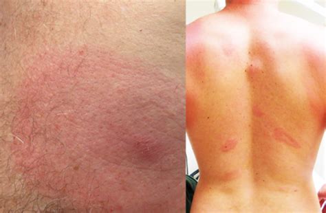 Inadequacy In The Medical Field To Accurately Diagnose A Lyme Rash
