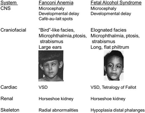 Comparison Of Birth Defects In Fanconi Anemia 28 And Fetal Alcohol