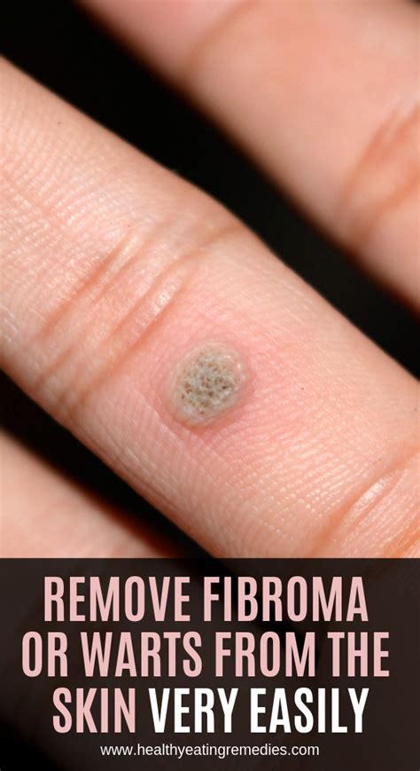 Remove Fibroma Or Warts From The Skin Very Easily Warts Natural