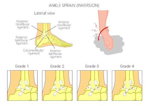 How And Why Does Inversion Ankle Sprain Affect Athletes