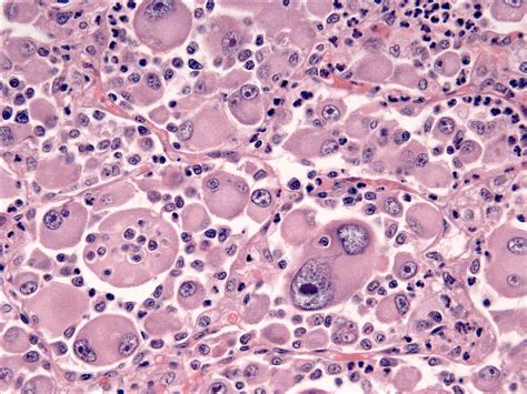 Histiocytic Sarcoma Complex General Considerations Histiocytosis