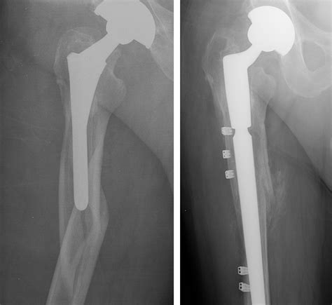 Thigh Pain After Hip Replacement After Hip Surgery 2019 12 31