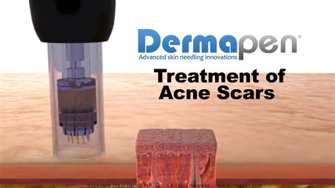 Microneedling For Acne Scars Dermapen Treatment Youtube
