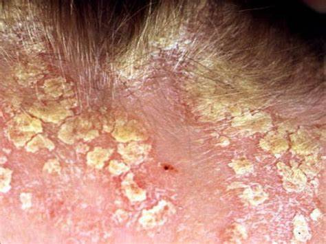 Себорейный дерматит лечение диетой Себорейный дерматит – причины, лечение на лице, на голове, профилактика Себорейный дерматит – причины, лечение на лице, на голове, профилактика Себорейный дерматит лечение диетой