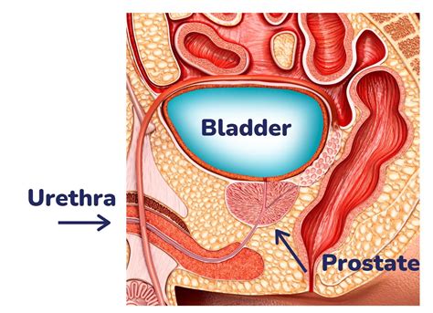 Prostate Conditions Northern Beaches Interventional Radiology