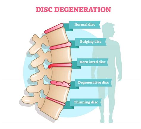 Degenerative Disc Disease Treatment Zaker Chiropractic