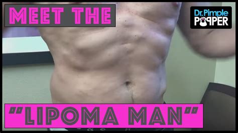 Introducingself Proclaimed Lipoma Man With Updates Youtube
