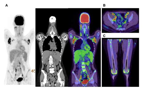 18 F Fdg Pet Of A Patient With Adult Onset Stills Disease A Coronal
