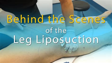 Lipo 360 Legs Lipedema Liposuction Surgery Cankles Ankles Calves