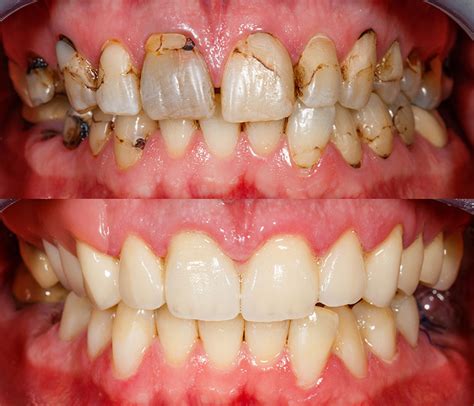 Composite Bonding London Tooth Bonding From Just £595