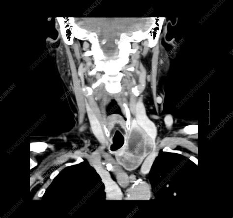 Ct Of Neck Showing Thyroid Goiter Stock Image F0319893 Science