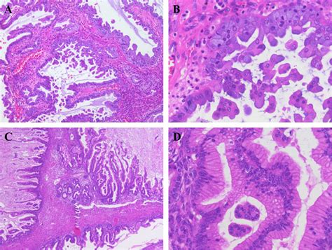 Ovarian Seromucinous Borderline Tumors Are Histologically Different
