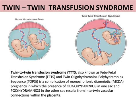Twin Twin Transfusion Syndrome Feto Fetal Transfusion 60 Off