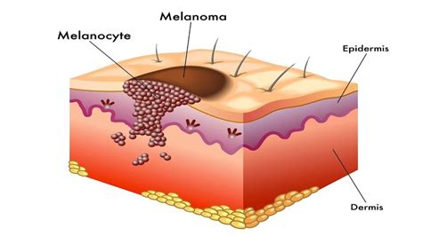 saulės draugas melanoma danis sauga