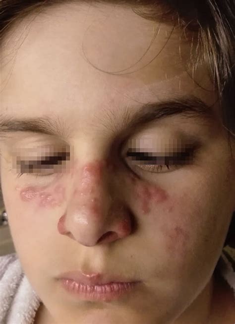 As with sle, there is a marked female. Localized discoid lupus erythematosus in plaques ...